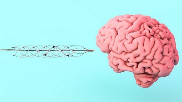 Beyin implantı - gələcəyin ünsiyyəti