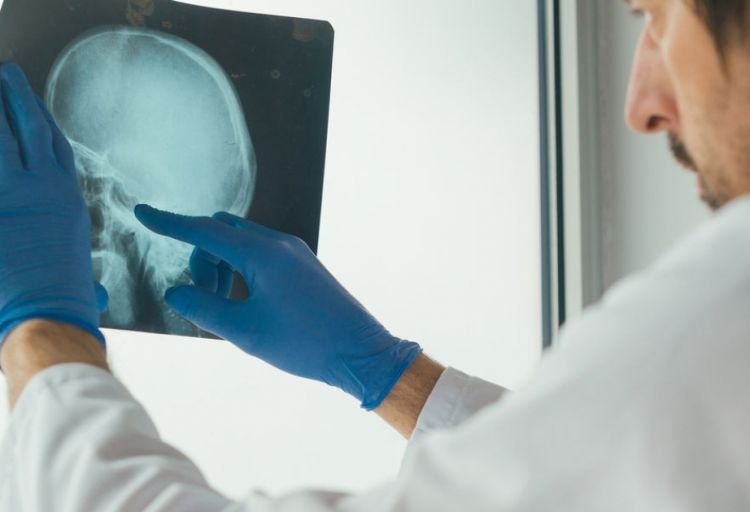 Tanınmış nevroloq insultun başlanğıc əlamətlərini sadalayıb