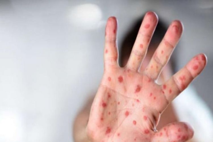 Ermənistanda qızılcaya yoluxanların sayı artır