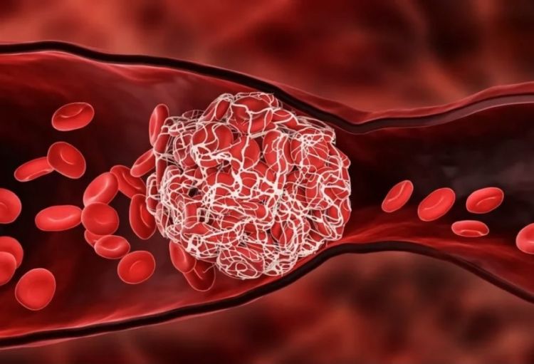 COVID yaşlı insanların damarlarında qan laxtalanması riskini kəskin artırır