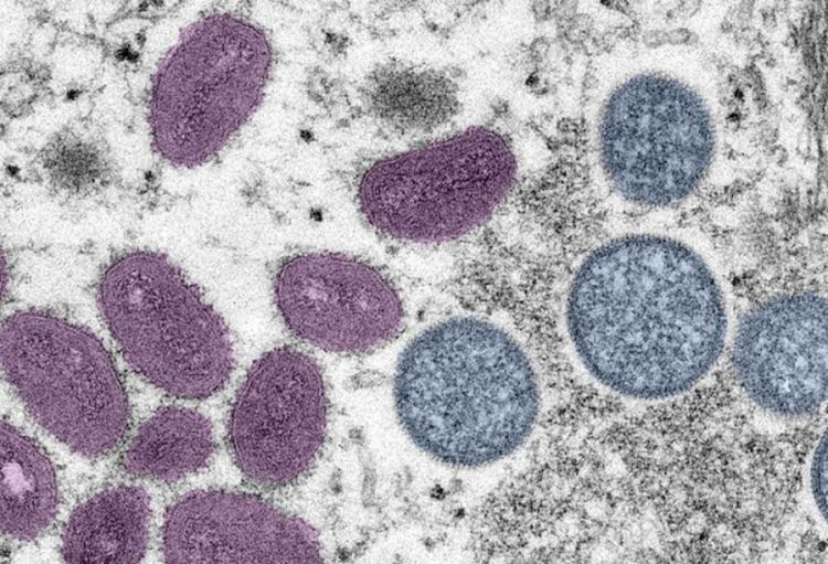 ÜST: Meymun çiçəyi artıq ictimai səhiyyə sahəsində fövqəladə vəziyyət təşkil etmir