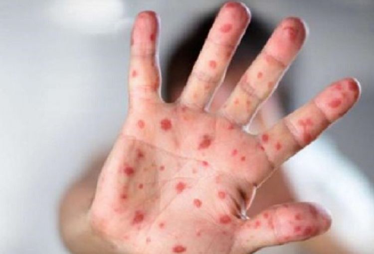 Gürcüstan epidemioloqları bu il ölkədə suçiçəyi xəstəliyinin artacağı barədə xəbərdarlıq ediblər