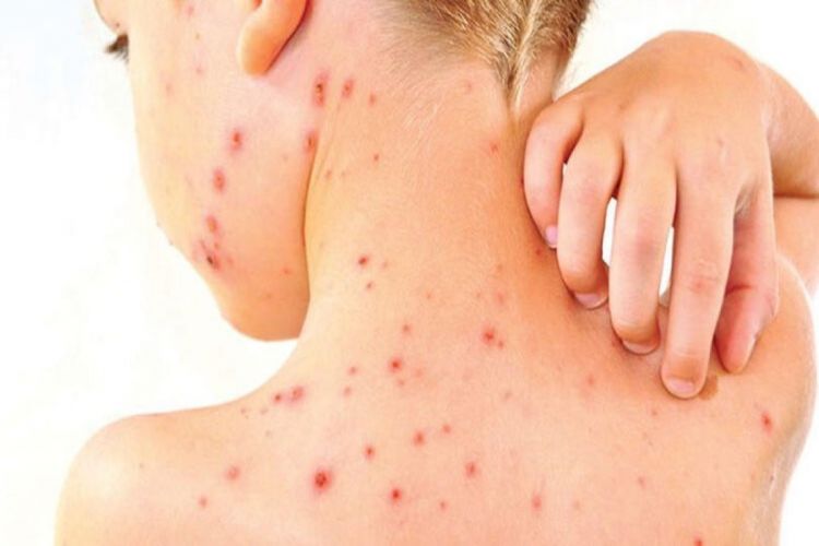 Ermənistanda qızılcaya yoluxanların sayı 185-ə çatıb, 133-ü uşaqdır