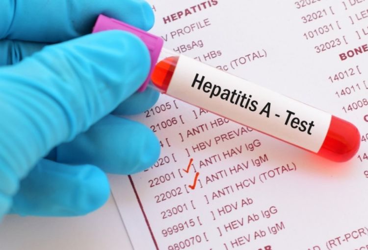 Hepatit A qaraciyər transplantasiyasına qədər gətirib çıxara bilər
