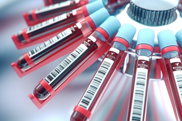 Sadə qan analizi ilə Parkinson xəstəliyinin qarşısını almaq mümkün olacaq