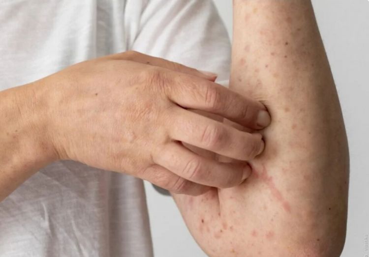 KİV: Londonun şimalında qızılca xəstəliyi yayılıb