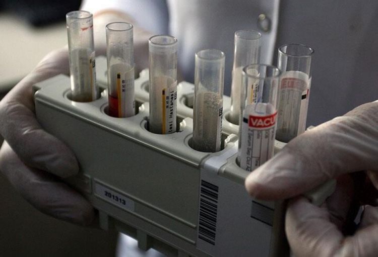 ÜST: Hepatit B infeksiyasının illik qlobal sayı 32 faiz azalıb