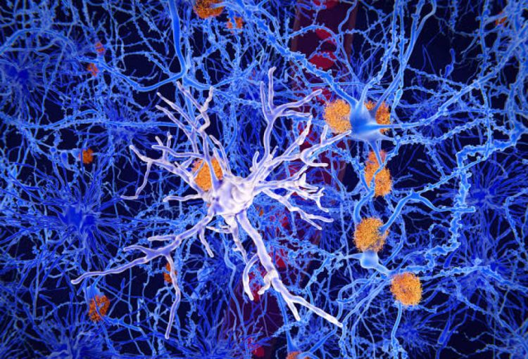 Alimlər Alzheimer xəstəliyinin beyin hüceyrələrini məhv etdiyi prosesi kəşf ediblər