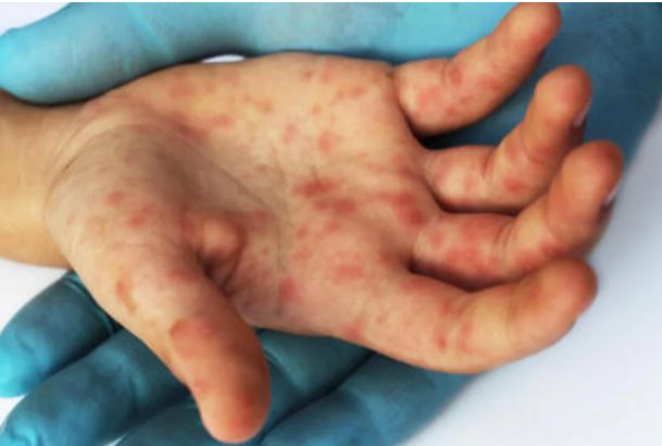 Pensilvaniyada qızılca epidemiyası qeydə alınıb